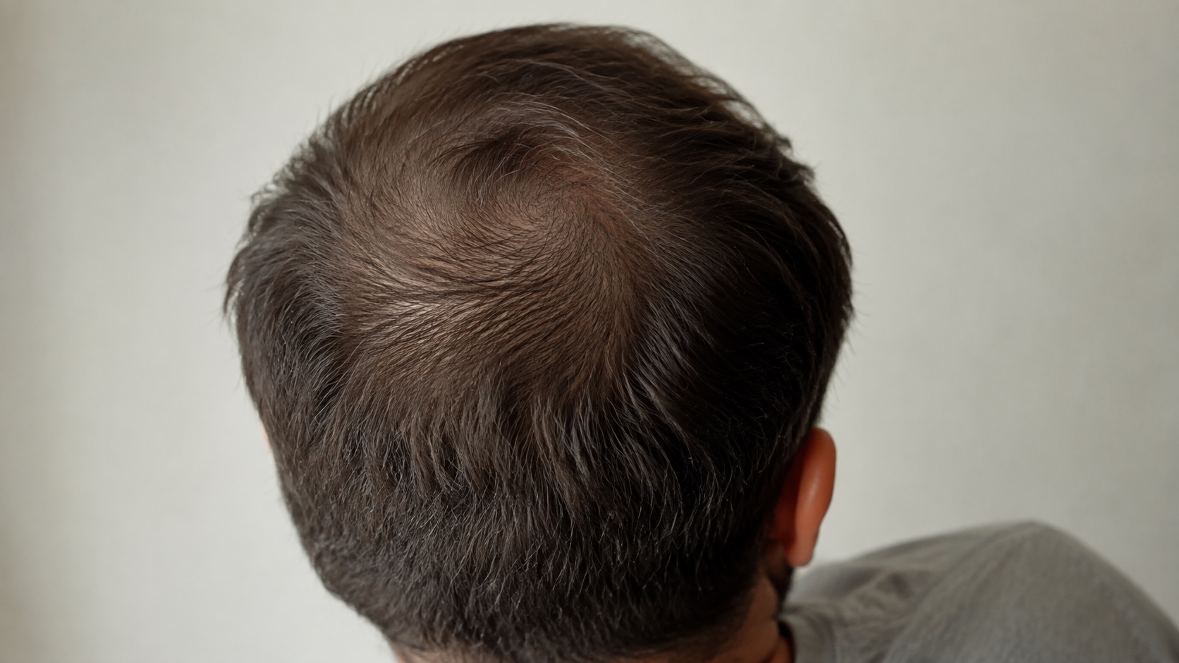 Illustrative close-up of thinning hair around an adult man’s crown